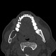 Keratocyst of mandible: CT - Computed tomography
