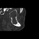 Keratocyst of mandible: CT - Computed tomography