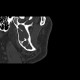 Keratocyst of mandible: CT - Computed tomography