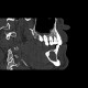 Keratocyst of mandible: CT - Computed tomography