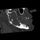 Keratocyst of mandible: CT - Computed tomography