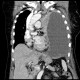 Collapse of lung wing, central tumour: CT - Computed tomography