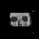 Comminuted fracture of facial skeleton: CT - Computed tomography