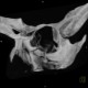 Comminuted fracture of facial skeleton: CT - Computed tomography