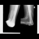 Congenital malformation of foot: X-ray - Plain radiograph