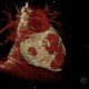 Constrictive pericarditis, VRT: CT - Computed tomography