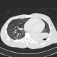 Lung contusion, hemothorax, pneumothorax, chest tube: CT - Computed tomography