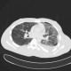 Lung contusion, hemothorax, pneumothorax, chest tube: CT - Computed tomography