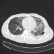 Lung contusion, hemothorax, pneumothorax, chest tube: CT - Computed tomography