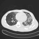 Lung contusion, hemothorax, pneumothorax, chest tube: CT - Computed tomography