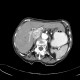 Renal carcinoma, Grawitz tumour, trombus in inferior vena cava, tumor thrombus: CT - Computed tomography