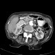 Renal carcinoma, Grawitz tumour, trombus in inferior vena cava, tumor thrombus: CT - Computed tomography