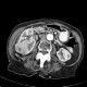 Renal carcinoma, Grawitz tumour, trombus in inferior vena cava, tumor thrombus: CT - Computed tomography