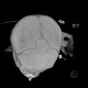 Coronal suture, bone island: CT - Computed tomography