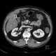Cortical scar of the kidney, agenesis of cortex of kidney, gallstone: CT - Computed tomography