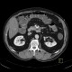 Cortical scar of the kidney, agenesis of cortex of kidney, gallstone: CT - Computed tomography