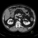 Cortical scar of the kidney, agenesis of cortex of kidney, gallstone: CT - Computed tomography