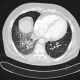 Alveolar hemorrhage: CT - Computed tomography