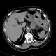 Intramural bleeding into transverse colon: CT - Computed tomography