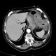 Intramural bleeding into transverse colon: CT - Computed tomography