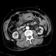 Intramural bleeding into transverse colon: CT - Computed tomography