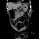 Intramural bleeding into transverse colon: CT - Computed tomography