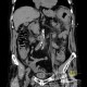 Intramural bleeding into transverse colon: CT - Computed tomography