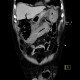 Intramural bleeding into transverse colon: CT - Computed tomography