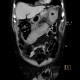 Intramural bleeding into transverse colon: CT - Computed tomography