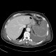 Renal hemorrhage, staghorn calculus: CT - Computed tomography