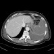 Renal hemorrhage, staghorn calculus: CT - Computed tomography