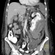 Renal hemorrhage, staghorn calculus: CT - Computed tomography