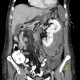 Renal hemorrhage, staghorn calculus: CT - Computed tomography