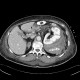 Renal hemorrhage, staghorn calculus: CT - Computed tomography