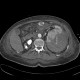 Renal hemorrhage, staghorn calculus: CT - Computed tomography