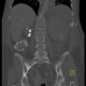 Renal hemorrhage, staghorn calculus: CT - Computed tomography