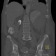 Renal hemorrhage, staghorn calculus: CT - Computed tomography