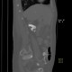 Renal hemorrhage, staghorn calculus: CT - Computed tomography