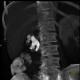 Renal hemorrhage, staghorn calculus, VRT: CT - Computed tomography