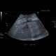 Renal hemorrhage, staghorn calculus: US - Ultrasound