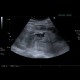 Renal hemorrhage, staghorn calculus: US - Ultrasound