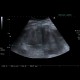 Renal hemorrhage, staghorn calculus: US - Ultrasound