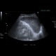 Renal hemorrhage, staghorn calculus: US - Ultrasound