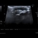 Calcification in patellar ligament, infrapatellar bursa: US - Ultrasound