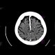 Intraparenchymal calcifications in brain: CT - Computed tomography