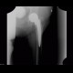 Calcifications in uterine fibroid, myoma, CEP, cervical endoprosthesis: X-ray - Plain radiograph