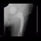 Calcifications in uterine fibroid, myoma, CEP, cervical endoprosthesis: X-ray - Plain radiograph