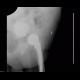 Calcifications in uterine fibroid, myoma, CEP, cervical endoprosthesis: X-ray - Plain radiograph