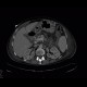 Chronic pancreatitis, calcified, nasojejunal tube: CT - Computed tomography