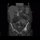 Chronic pancreatitis, calcified, nasojejunal tube: CT - Computed tomography